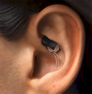 Image of STAT's in-ear device.